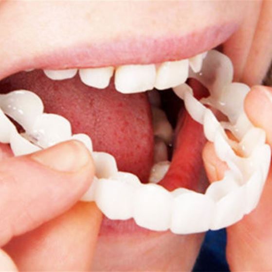 Snap-on Teeth™ – Mit diesen Veneers haben Sie immer ein perfektes Lächeln.