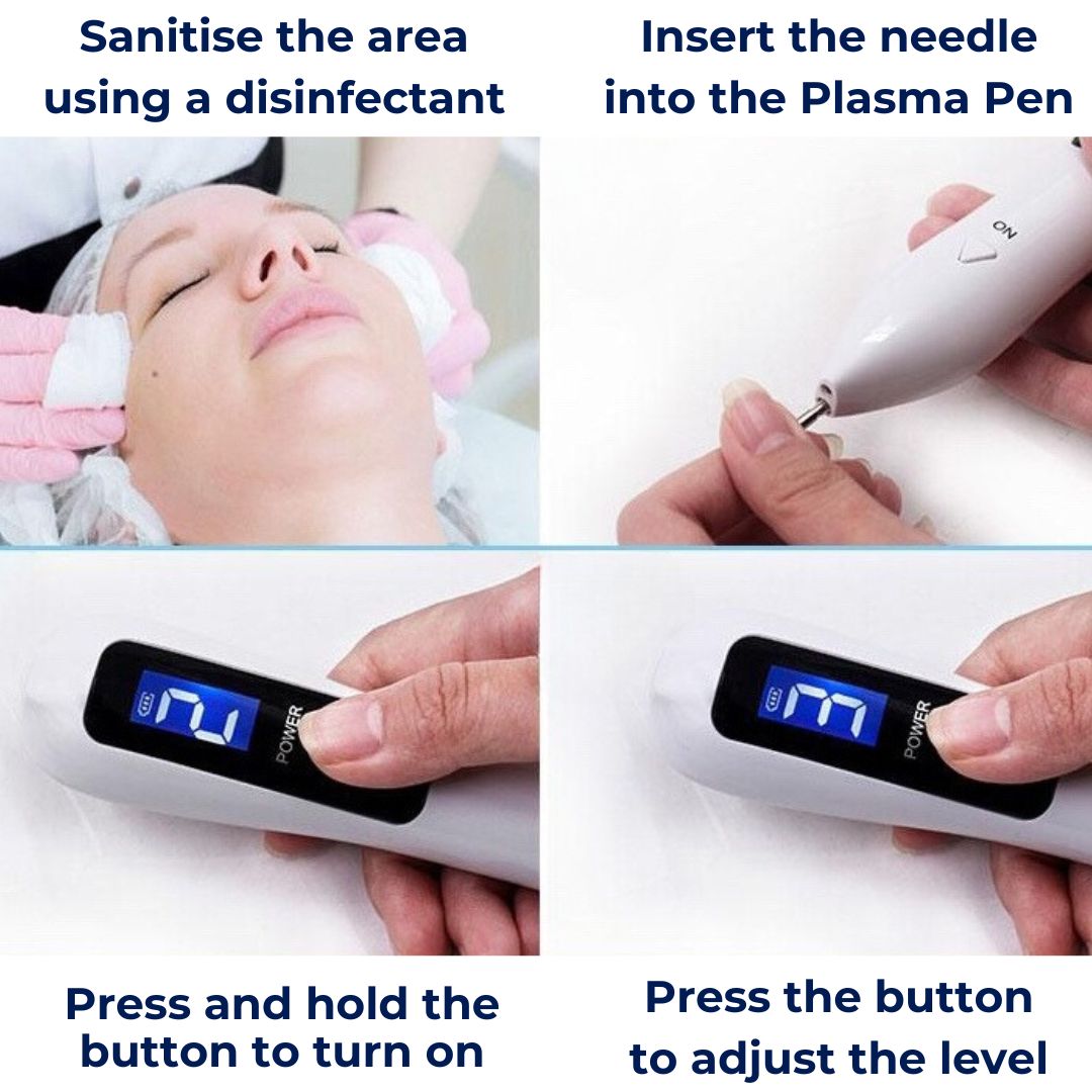 ClearSkinPro Laser Plasma Pen - Nicht-invasiv | zur Entfernung von Sommersprossen, Hautflecken, Punkten, Muttermalen und Tätowierungen zu Hause Karnz