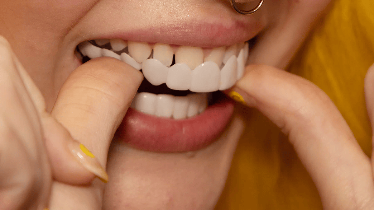 Sandsberg | Snap-On Smile Veneers | Sofortige Zahnaufhellung | Einheitsgröße