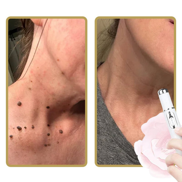 Karnz | ClearDerm - Schnelle, schmerzfreie Pickelentfernung für glatte, klare Haut