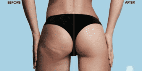 Anti-Cellulite-Vakuum-Silikonbecher | Karnz