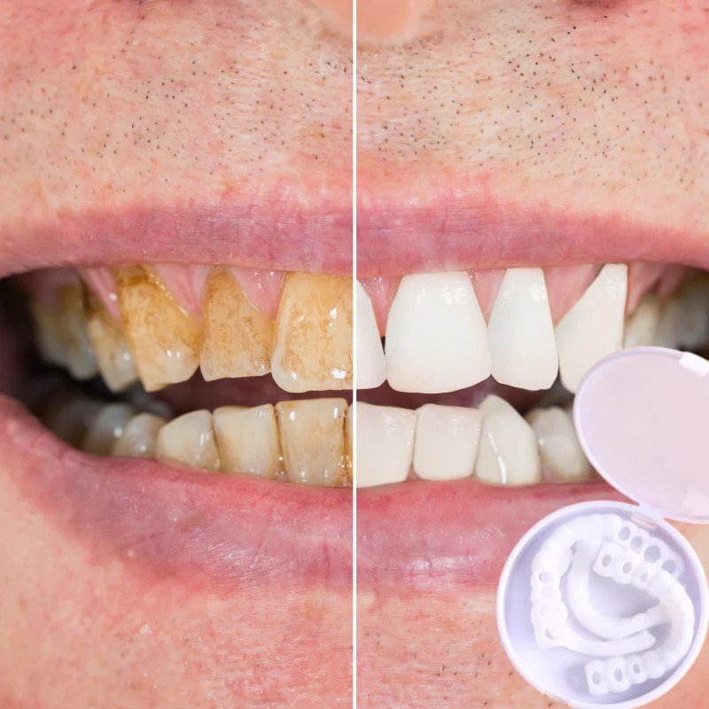 Karnz | SmileSnap Zahnverblendungen – Sofortiges Lächeln mit bequemer Passform