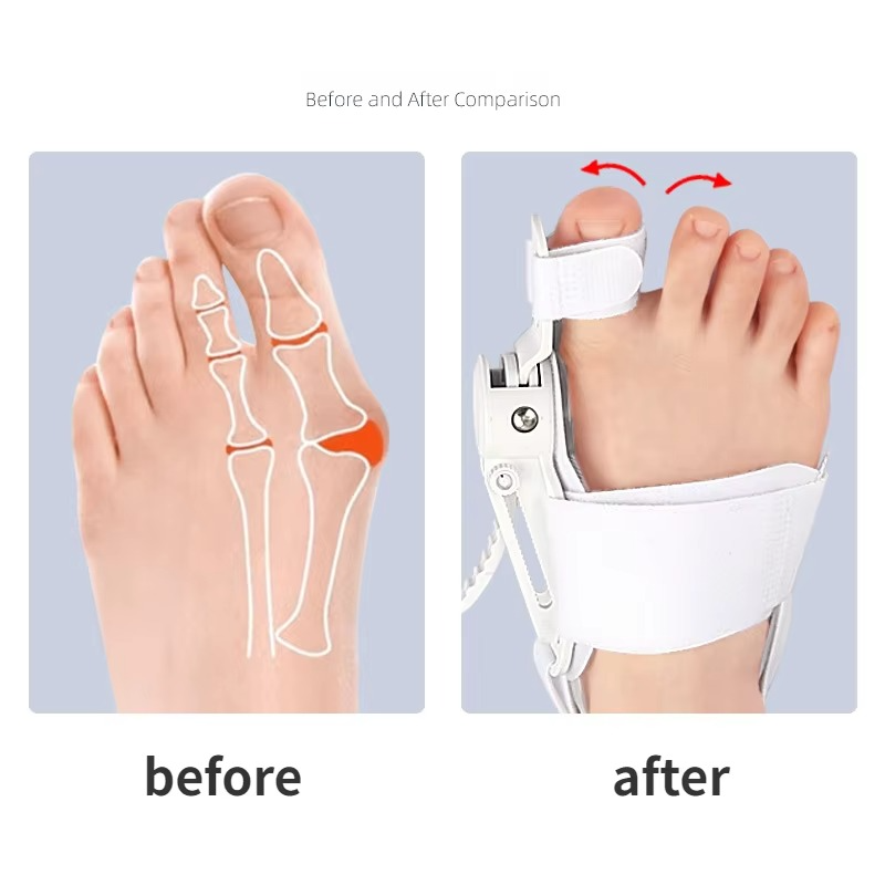 Hallux-valgus-Korrektur, Zehenspreizer, Fußausrichtungshilfe