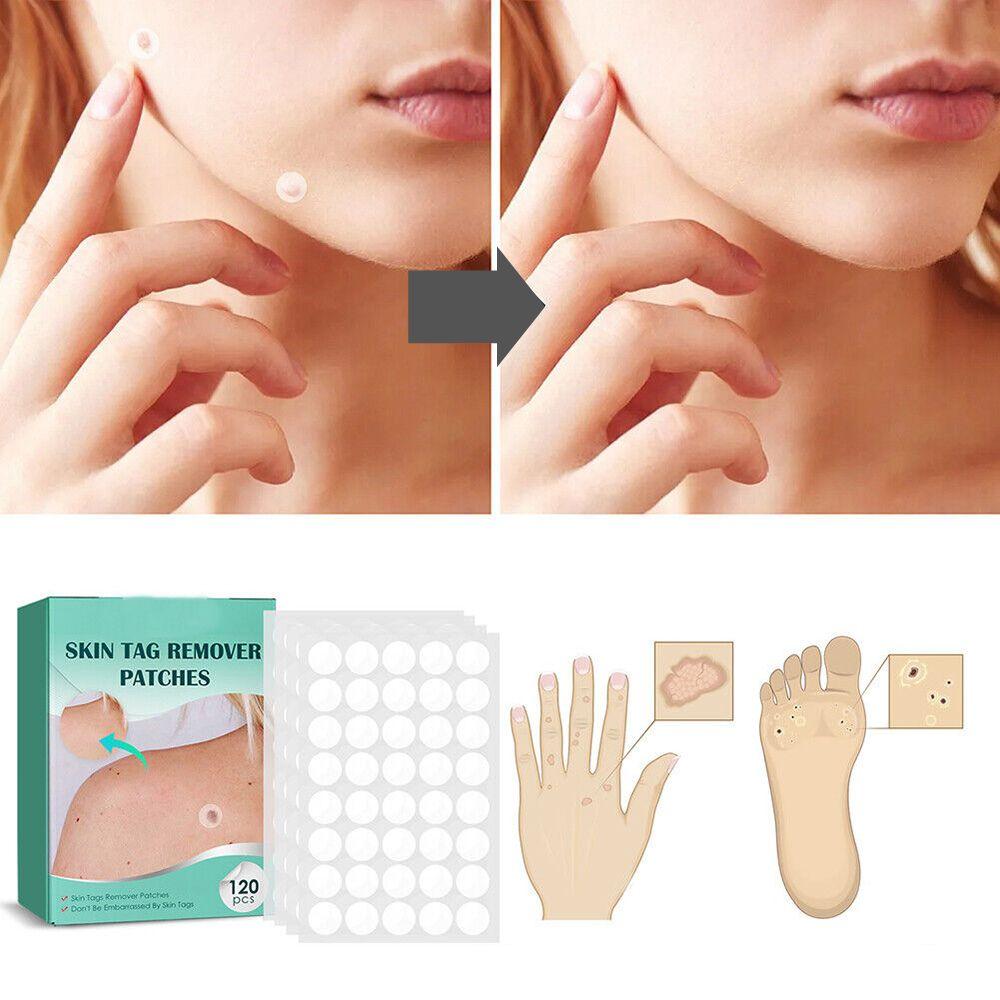 SkinClear - Pflaster zur Entfernung von Flecken und Warzen Karnz