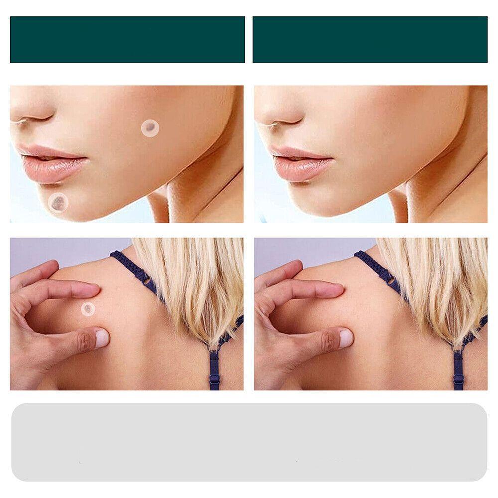 SkinClear - Pflaster zur Entfernung von Flecken und Warzen Karnz