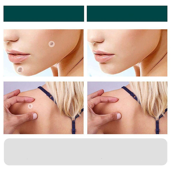SkinClear - Pflaster zur Entfernung von Flecken und Warzen Karnz