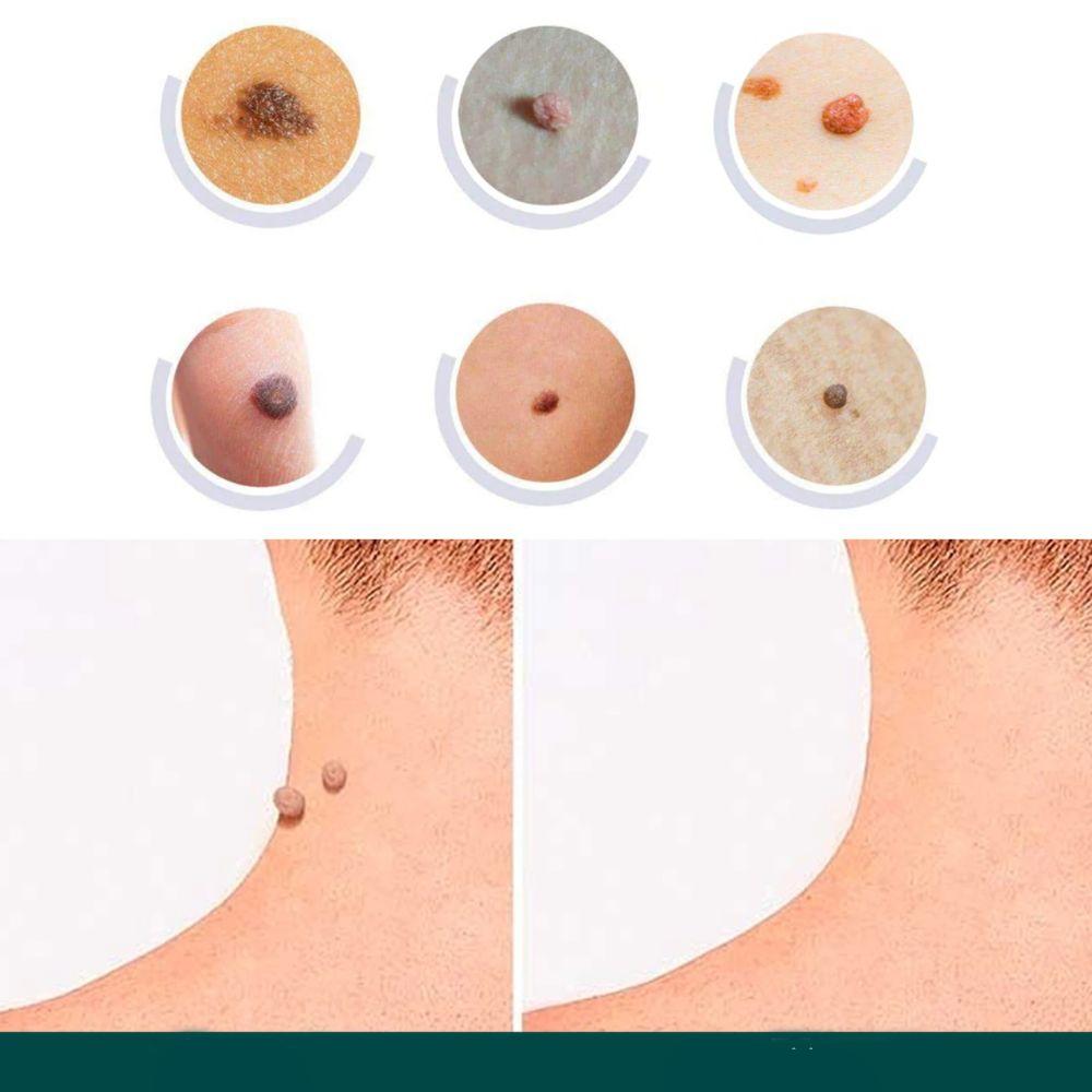 SkinClear - Pflaster zur Entfernung von Flecken und Warzen Karnz