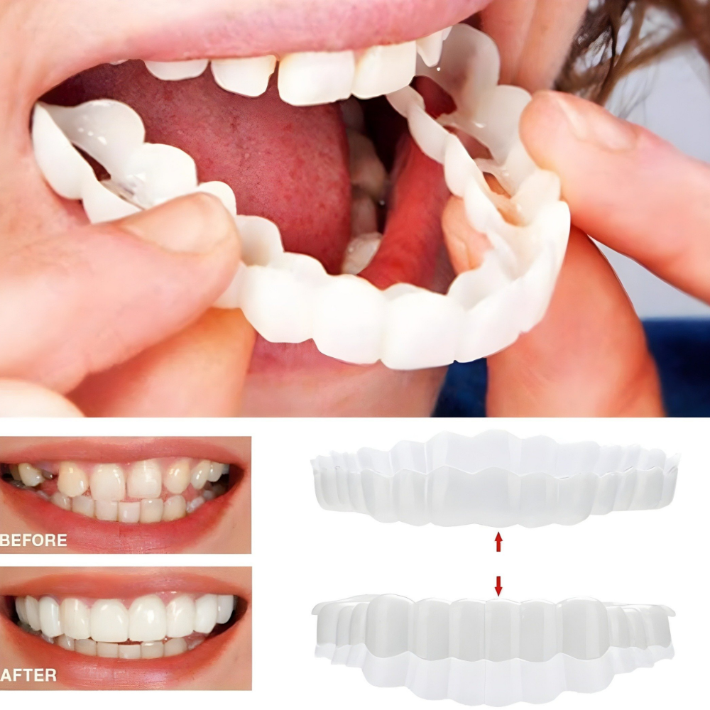 Herausnehmbare Veneers-Zahnverblendschalen