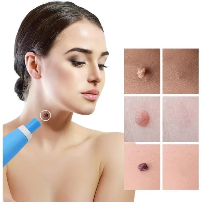 Skin Tag Entferner Kit | Nicht-invasiv & Effektiv | Karnz