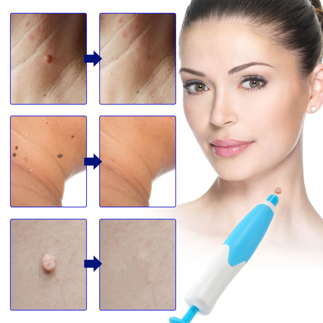 Skin Tag Entferner Kit | Nicht-invasiv & Effektiv | Karnz