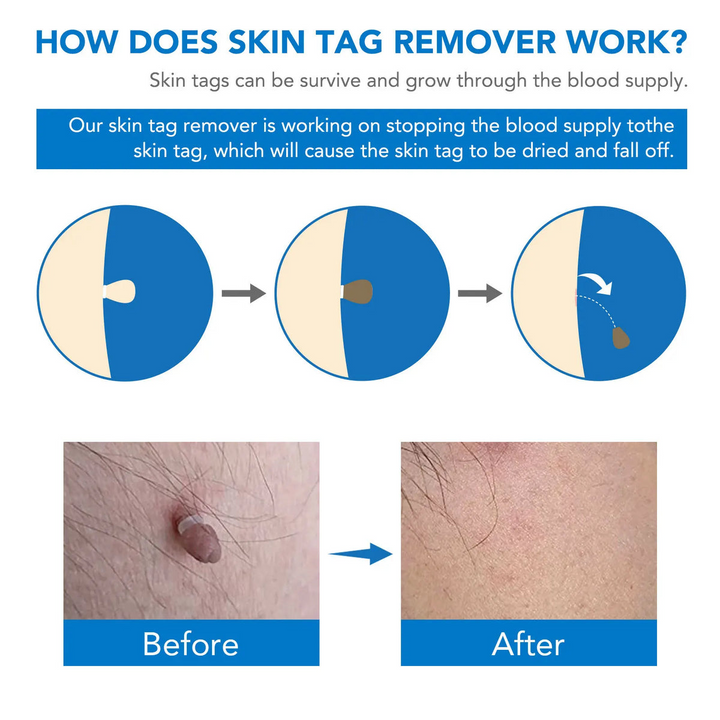 Skin Tag Entferner Kit | Nicht-invasiv & Effektiv | Karnz