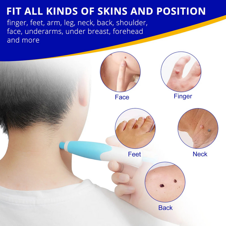 Skin Tag Entferner Kit | Nicht-invasiv & Effektiv | Karnz
