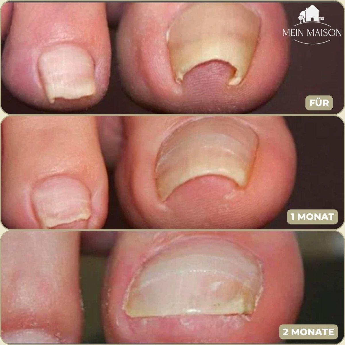 ALIGNSTRIP – Schmerzfreie Nagelkorrekturstreifen für eingewachsene und deformierte Nägel