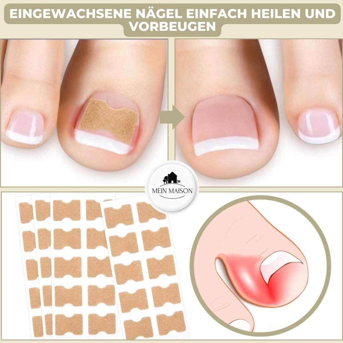 ALIGNSTRIP – Schmerzfreie Nagelkorrekturstreifen für eingewachsene und deformierte Nägel