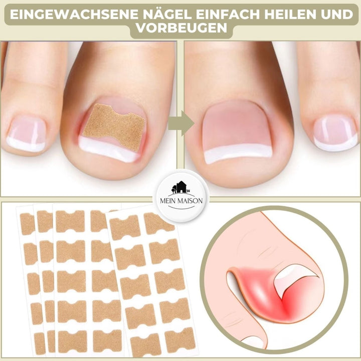 ALIGNSTRIP – Schmerzfreie Nagelkorrekturstreifen für eingewachsene und deformierte Nägel