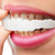 Herausnehmbare Veneers-Zahnverblendschalen
