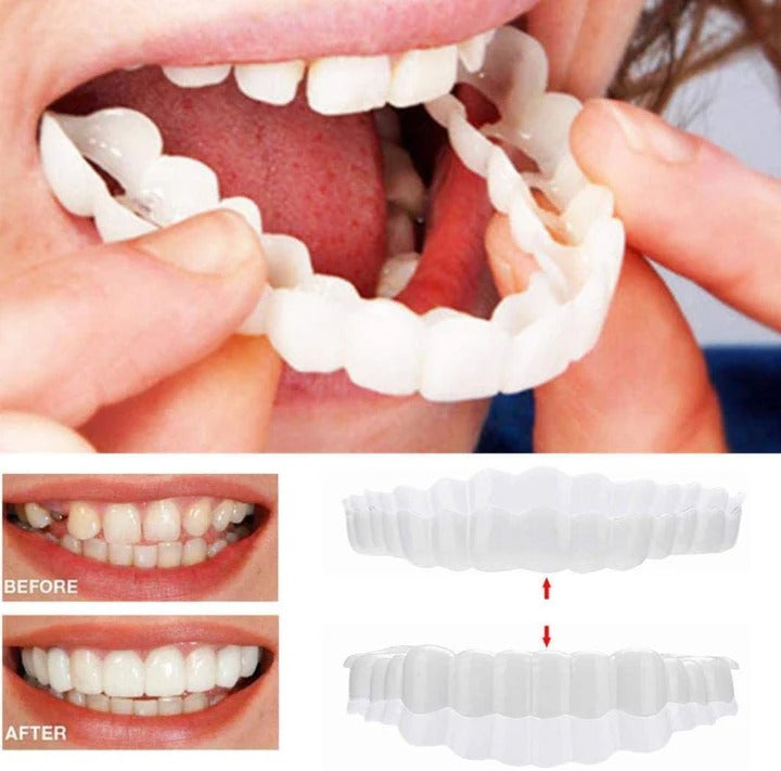Herausnehmbare Veneers für Ober- und Unterkieferzähne
